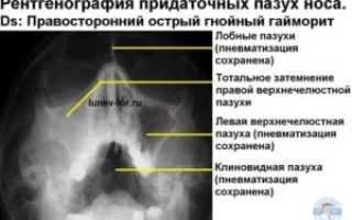 Рентген онп что это