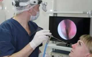 Полипы в гайморовой пазухе лечение