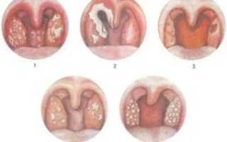Зев гиперемирован что значит