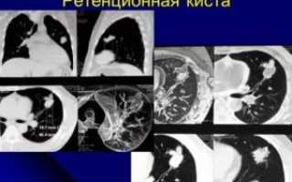 Ретенционные кисты легких