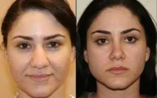 Широкий нос что делать