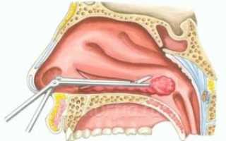 Конхотомия нижних носовых раковин
