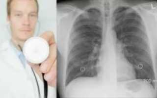 Пневмония не прослушивается