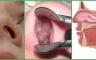 Отёк в носу у ребёнка фото