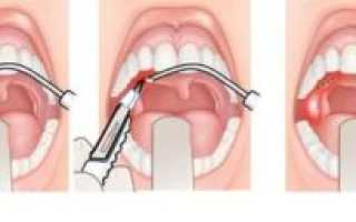 Паратонзиллярный абсцесс лечение после вскрытия