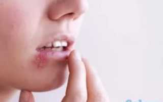 Как быстро избавиться от простуды на лице