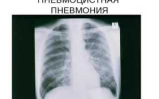 Пневмоцистная пневмония рентгенологическая картина