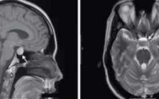 Синусопатия головного мозга что это такое