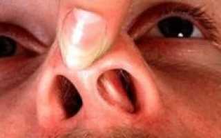 Горит в носу что делать