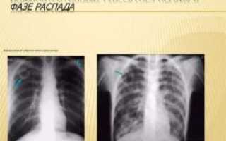 Инфильтративный туберкулёз в фазе распада