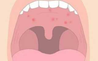 Налет на задней стенке глотки