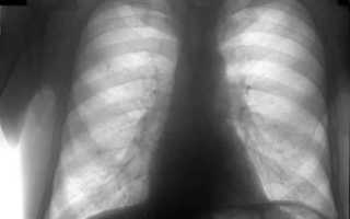 Можно ли по флюорографии определить пневмонию