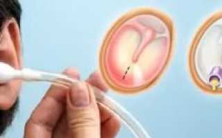 Прокол барабанной перепонки у ребенка