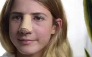 Как убрать сливу с носа быстро