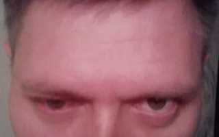 Опух лоб над бровями