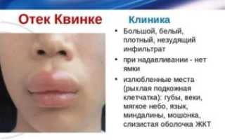 Отёк квинке симптомы и лечение у детей