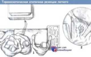 Атипичная резекция легкого