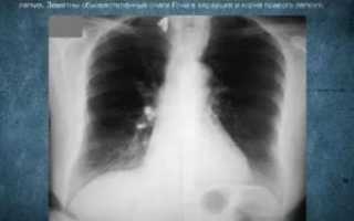 Обызвествленный очаг в легких что это