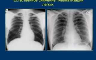 Легочные поля пневматизированы что это значит