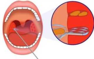 На миндалинах красные сосуды у ребенка