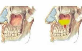 Соустье гайморовой пазухи
