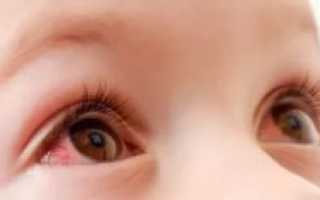 У ребенка красные глаза и температура