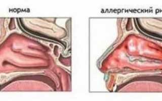 Раздражение слизистой носа лечение