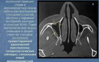 Утолщение слизистой оболочки верхнечелюстных пазух