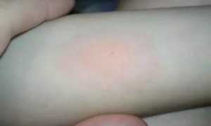 Осложнения после манту у ребенка