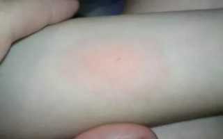 Осложнения после манту у ребенка