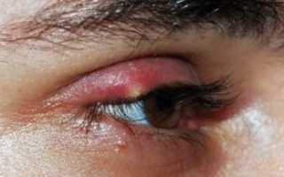 Простуда на глазу как лечить