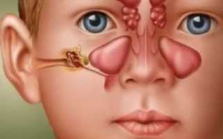 Забиты пазухи носа что делать