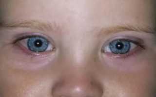 Можно при коньюктивите гулять на улице