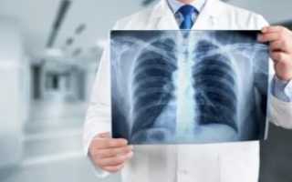 Как обмануть флюорографию