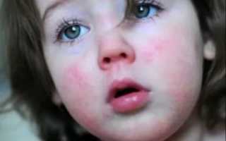 Сыпь при орви у ребенка фото