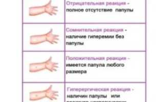 Когда нельзя ставить манту ребенку