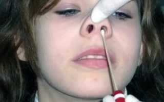 Рак слизистой носа симптомы фото