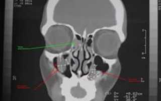 Полип правой верхнечелюстной пазухи