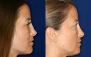 Как скрыть горбинку на носу