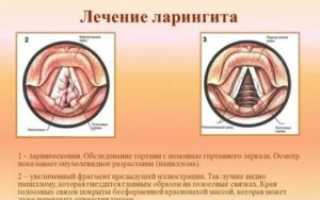Болезни голосовых связок симптомы лечение