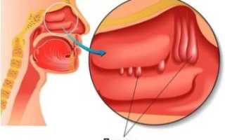 Отек слизистой носа при беременности лечение