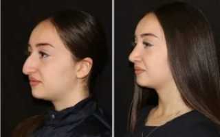 Не дышит нос после ринопластики