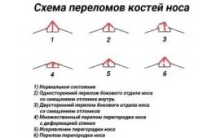 Перелом носа какой вред здоровью