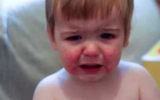 Почему у ребенка красные щечки