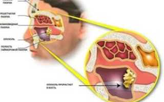 Опухоль в пазухе носа