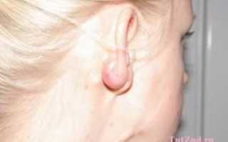 Абсцесс мочки уха