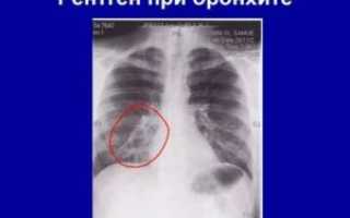 Рентген при бронхите у детей