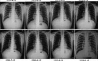 Вялотекущая пневмония симптомы у взрослых