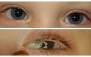 Зеленые выделения из глаз у ребенка