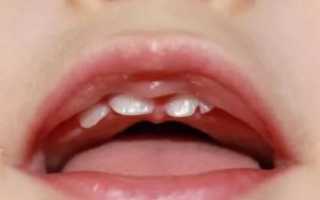 Красное горло при прорезывании зубов у детей